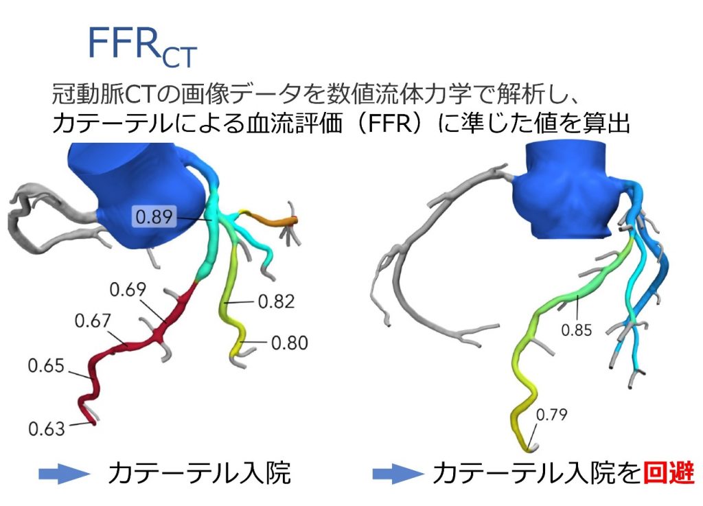 冠動脈CTの画像データを数値流体力学で解析し、カテーテルによる血流評価(FFR)に準じた値を算出。
