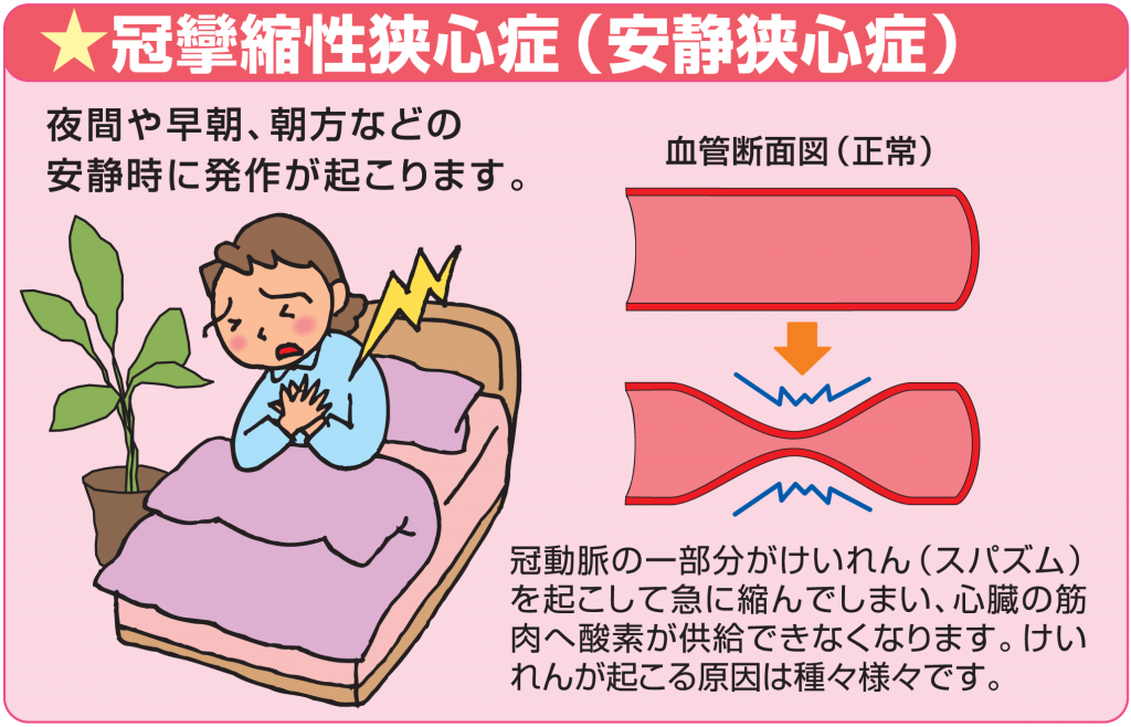 夜間や早朝、朝方などの安静時に発作が起こります。冠動脈の一部分がけいれん(スパズム)を起こして急に縮んでしまい、心臓の筋肉へ酸素が供給できなくなります。けいれんが起こる原因は種々様々です。