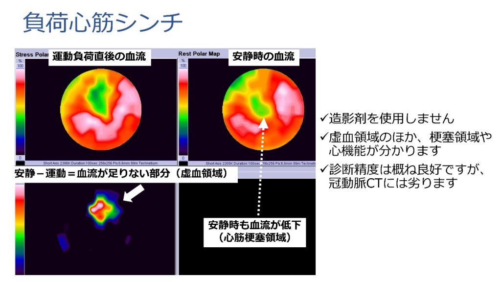 造影剤を使用しません。虚血領域のほか、梗塞領域や心機能が分かります。診断精度は概ね良好ですが、冠動脈CTには劣ります。