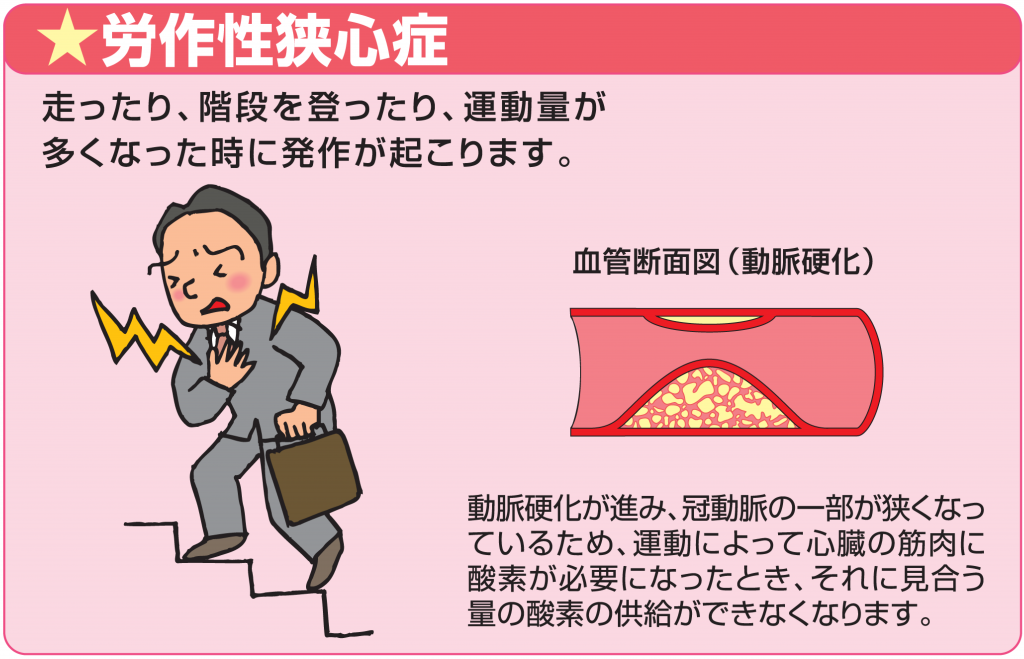 走ったり、階段を登ったり、運動量が多くなった時に発作が起こります。動脈硬化が進み、冠動脈の一部が狭くなっているため、運動によって心臓の筋肉に酸素が必要になったとき、それに見合う量の酸素の供給ができなくなります。